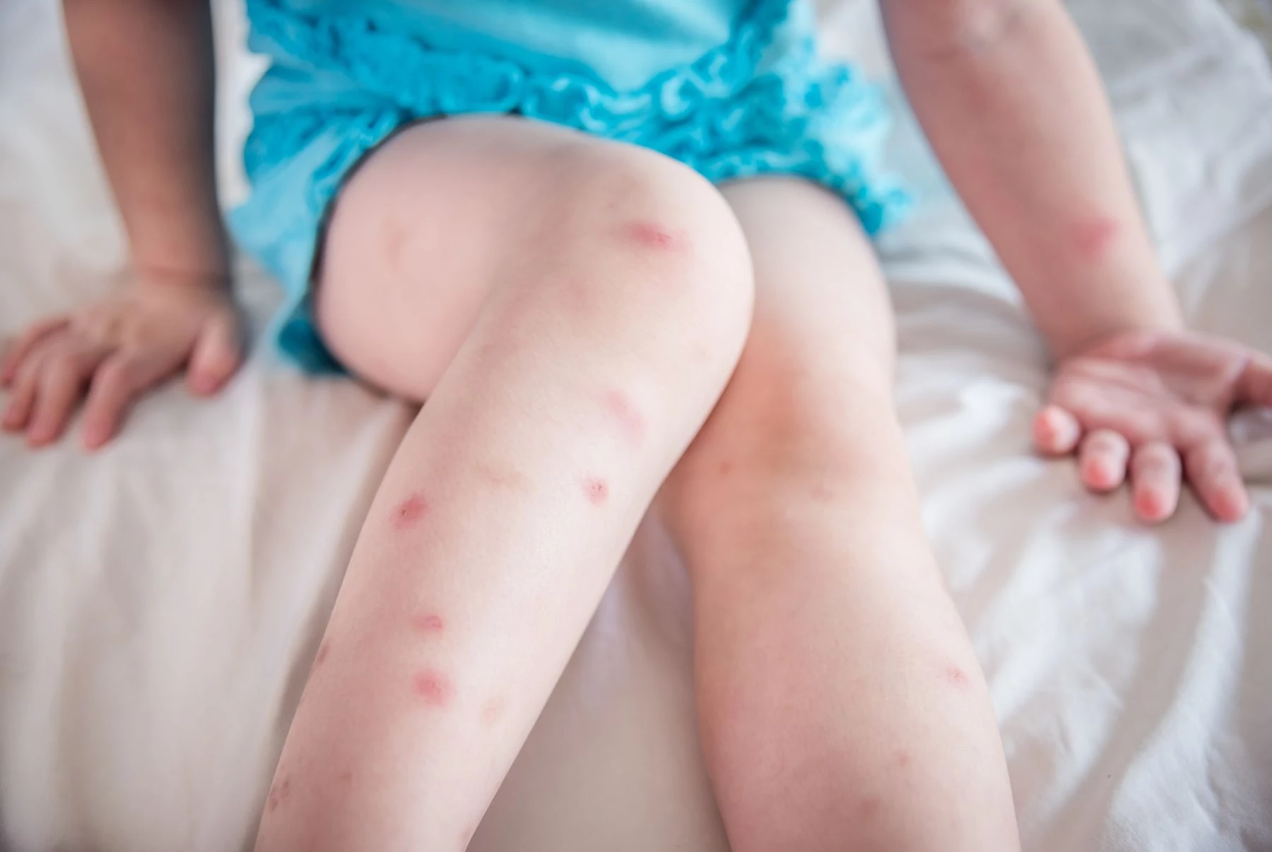 Làm thế nào để giảm thiểu các vấn đề về muỗi trong khuôn viên khách sạn của bạn